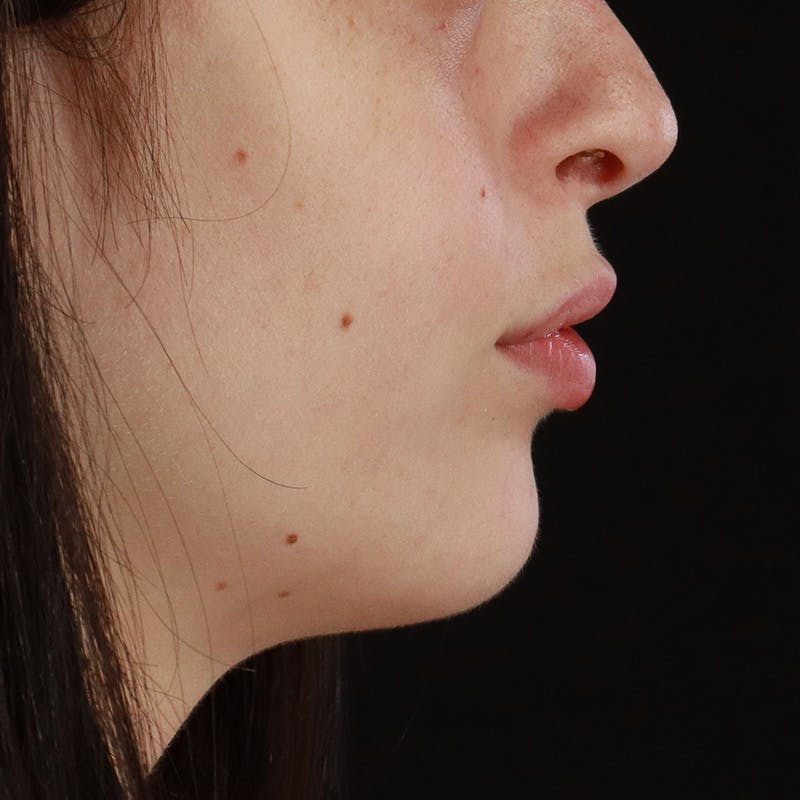 Dermal Fillers Before & After Gallery - Patient 126980 - Image 5