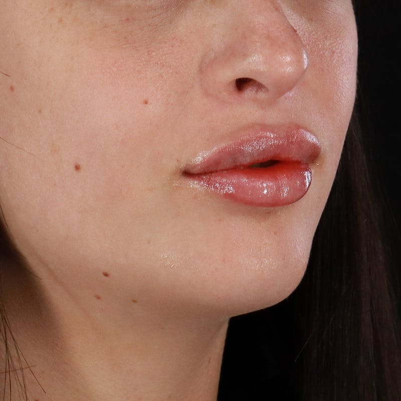 Dermal Fillers Before & After Gallery - Patient 126980 - Image 4