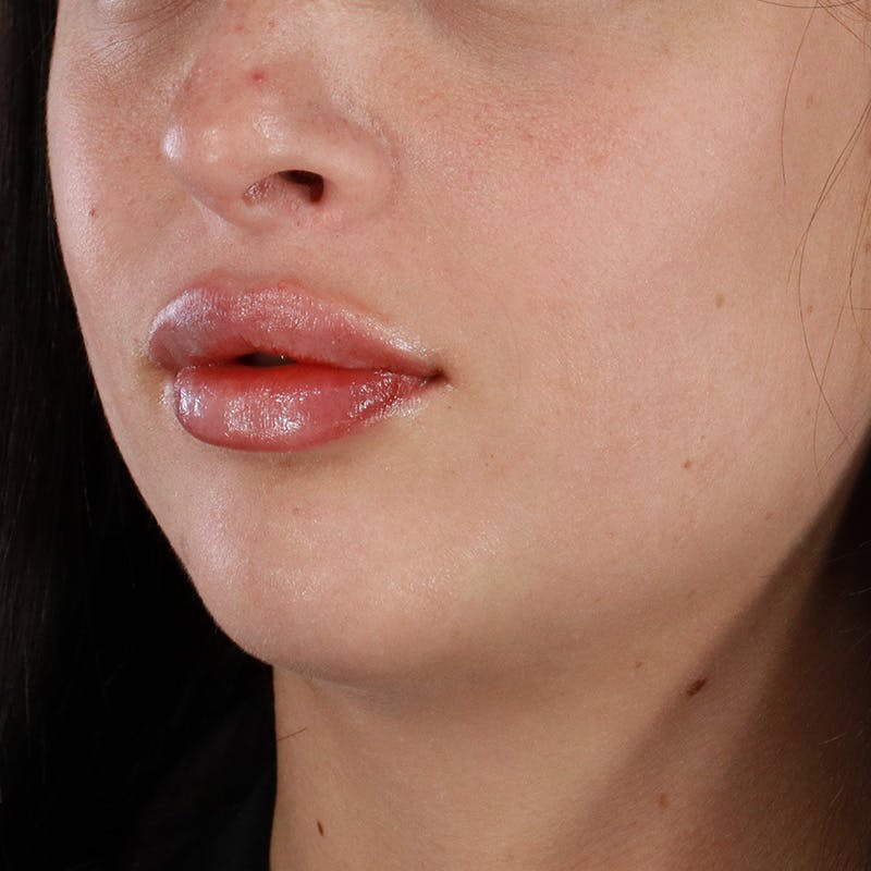 Dermal Fillers Before & After Gallery - Patient 126980 - Image 8