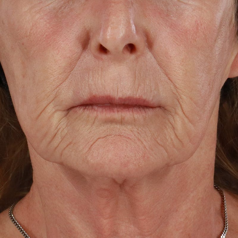 Dermal Fillers Before & After Gallery - Patient 381475 - Image 1