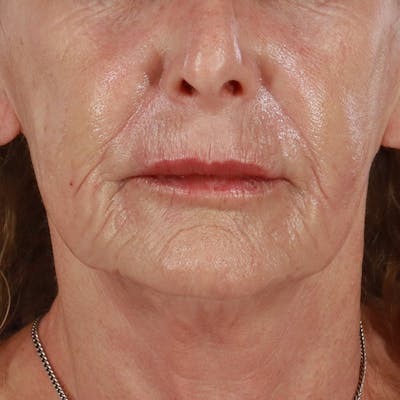 Dermal Fillers Before & After Gallery - Patient 381475 - Image 2