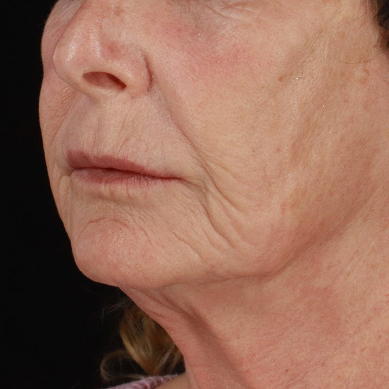 Dermal Fillers Before & After Gallery - Patient 381475 - Image 5