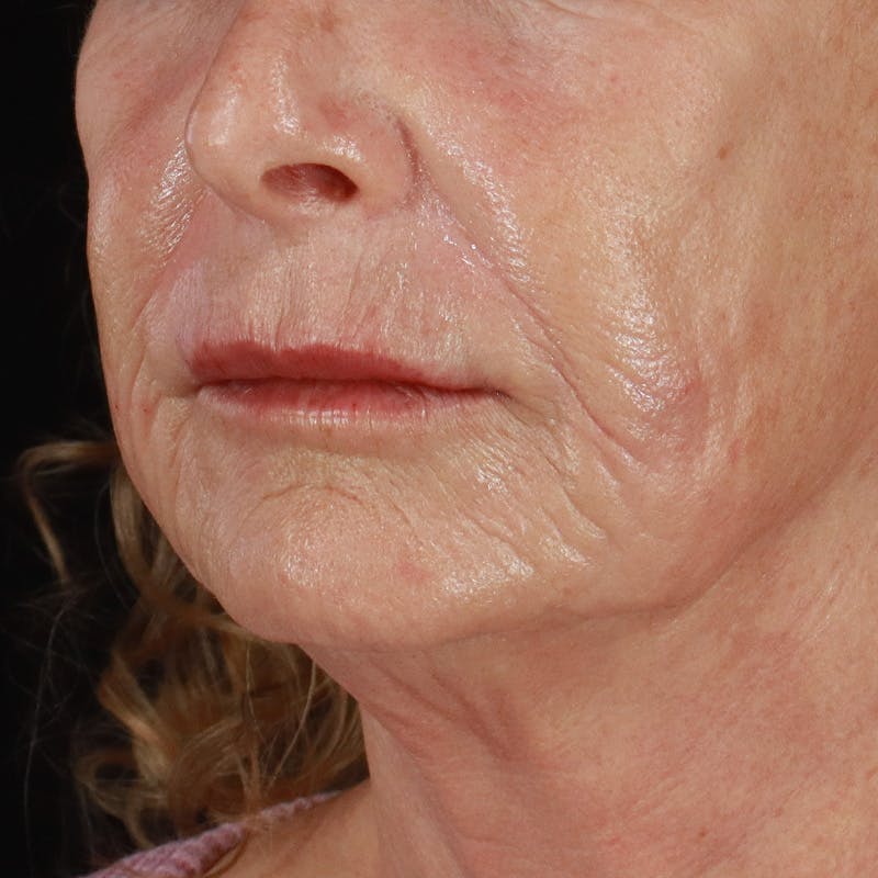 Dermal Fillers Before & After Gallery - Patient 381475 - Image 6