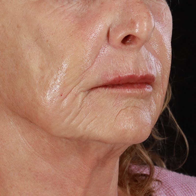 Dermal Fillers Before & After Gallery - Patient 381475 - Image 4