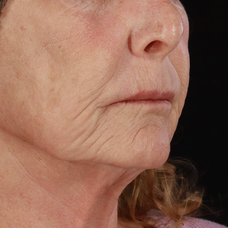Dermal Fillers Before & After Gallery - Patient 381475 - Image 3