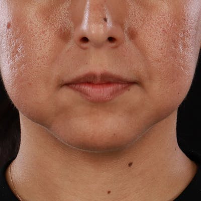 Dermal Fillers Before & After Gallery - Patient 305824 - Image 1