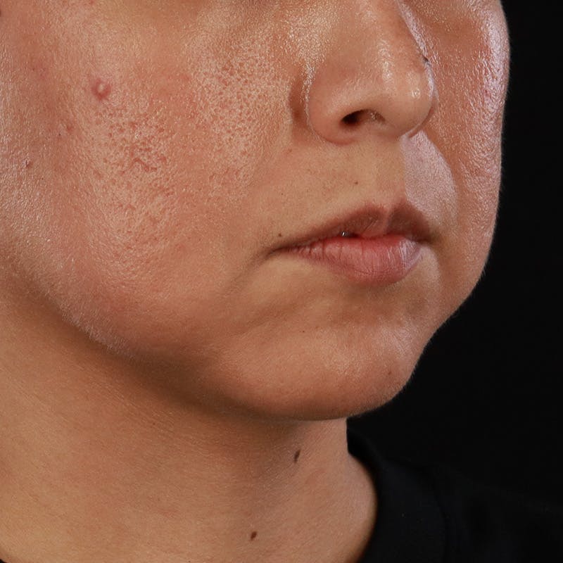 Dermal Fillers Before & After Gallery - Patient 305824 - Image 3