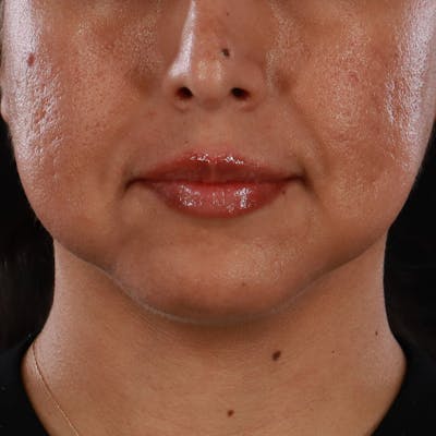 Dermal Fillers Before & After Gallery - Patient 305824 - Image 2