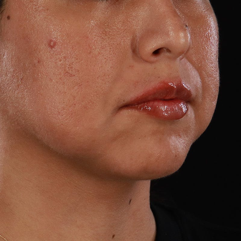 Dermal Fillers Before & After Gallery - Patient 305824 - Image 4
