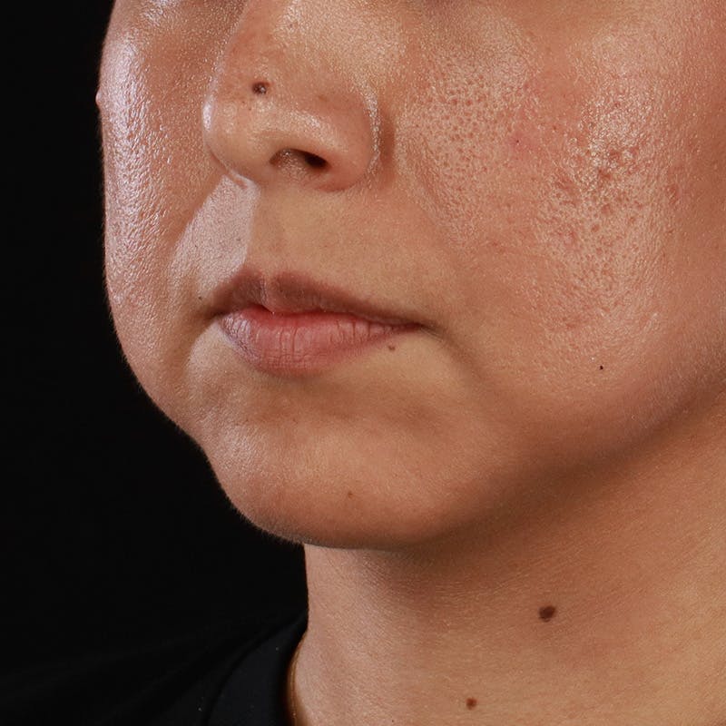 Dermal Fillers Before & After Gallery - Patient 305824 - Image 5