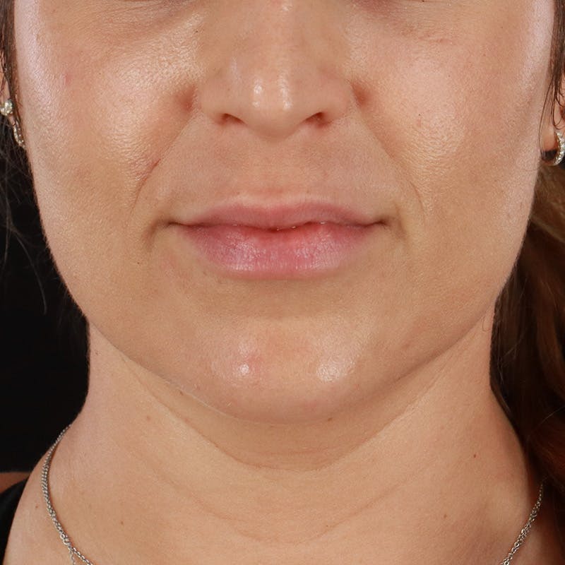 Lip Lift Before & After Gallery - Patient 281153 - Image 1