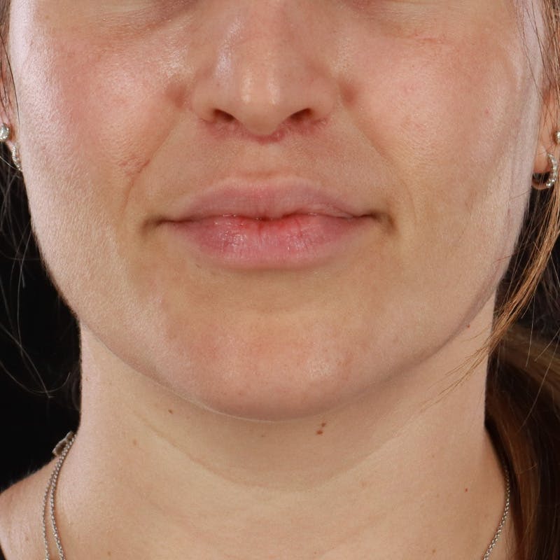 Lip Lift Before & After Gallery - Patient 281153 - Image 2