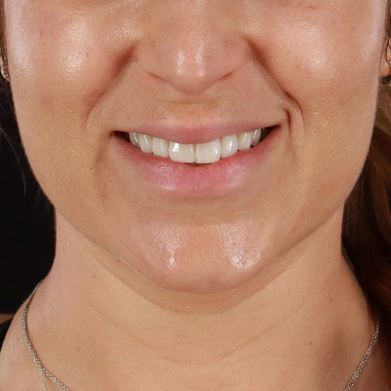 Lip Lift Before & After Gallery - Patient 281153 - Image 3