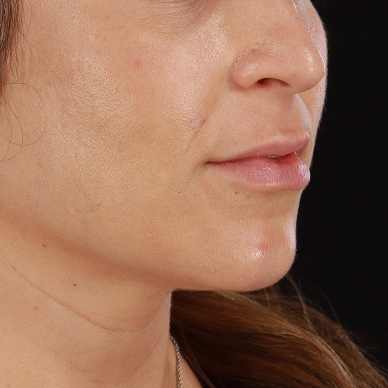 Dermal Fillers Before & After Gallery - Patient 759791 - Image 5