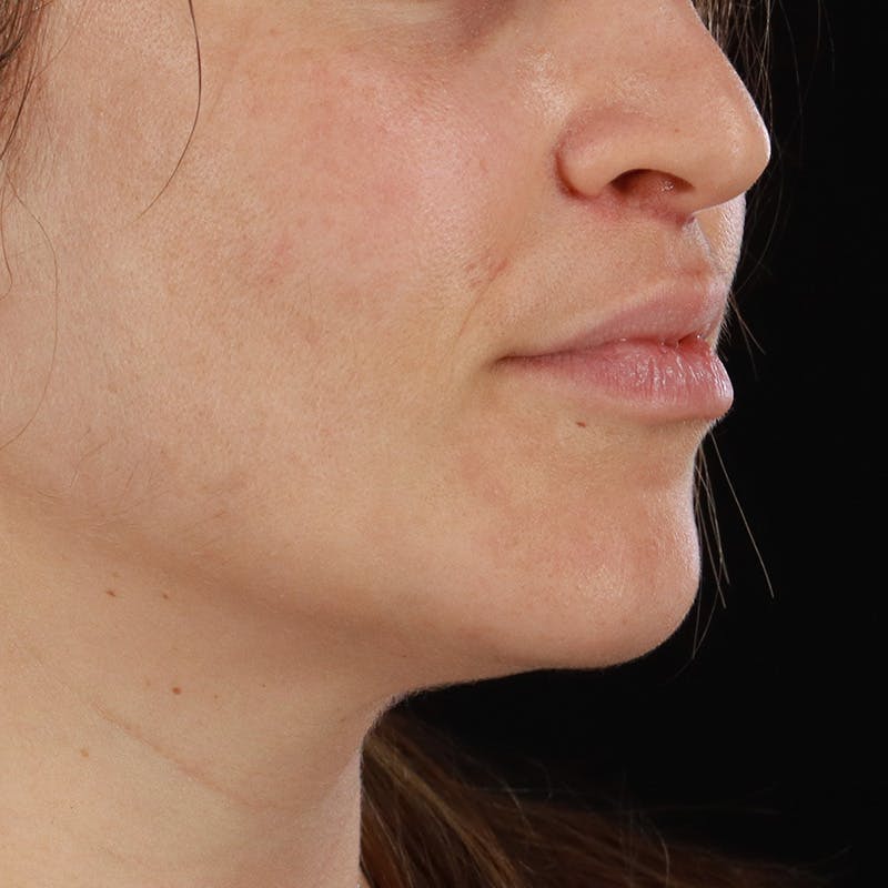 Dermal Fillers Before & After Gallery - Patient 759791 - Image 6