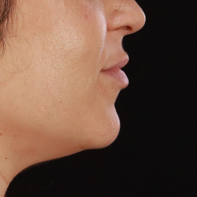 Lip Lift Before & After Gallery - Patient 281153 - Image 7