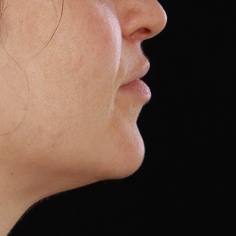 Lip Lift Before & After Gallery - Patient 281153 - Image 8