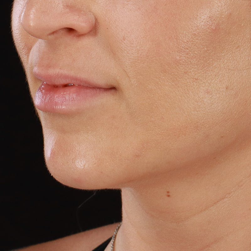 Lip Lift Before & After Gallery - Patient 281153 - Image 9
