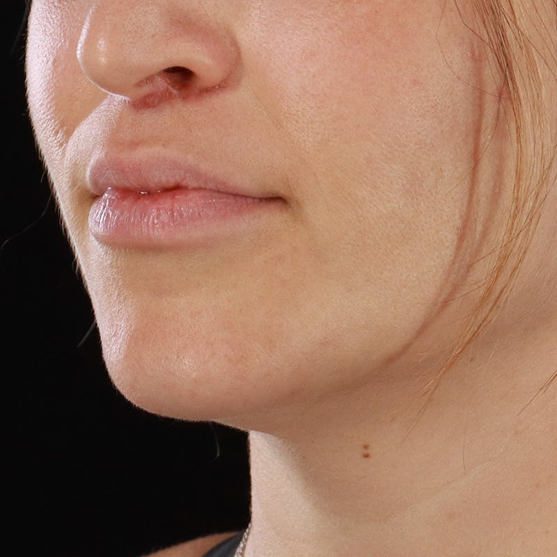 Dermal Fillers Before & After Gallery - Patient 759791 - Image 10