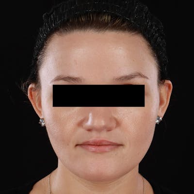 Botox/Dysport/Jeuveau Before & After Gallery - Patient 688390 - Image 1