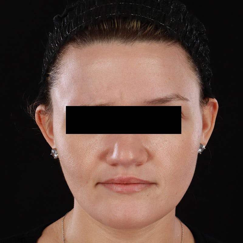 Botox/Dysport/Jeuveau Before & After Gallery - Patient 688390 - Image 3