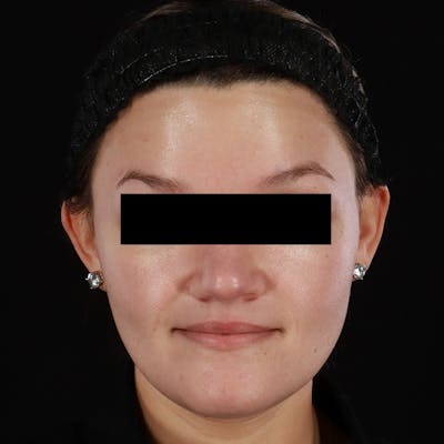 Botox/Dysport/Jeuveau Before & After Gallery - Patient 688390 - Image 2