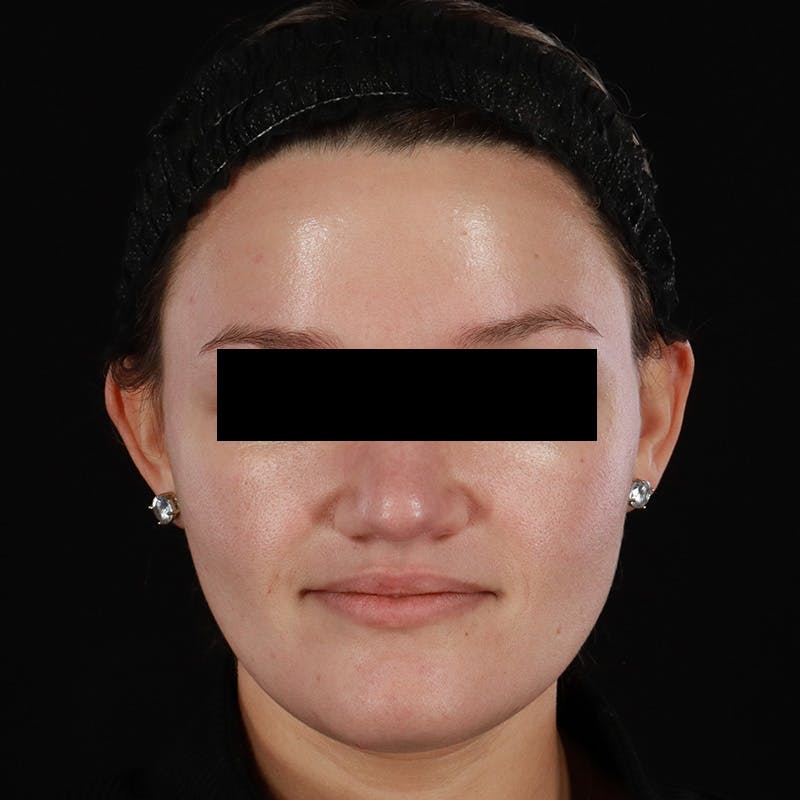 Botox/Dysport/Jeuveau Before & After Gallery - Patient 688390 - Image 6