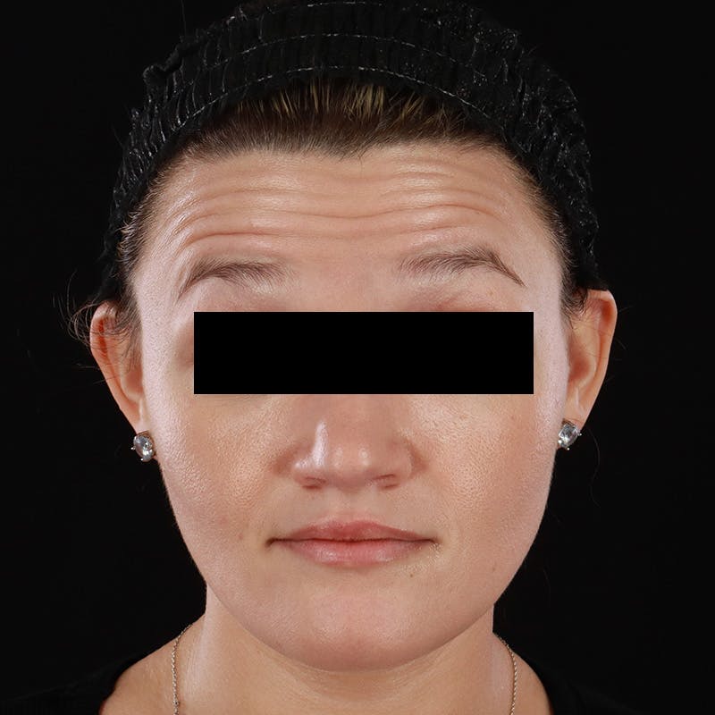 Botox/Dysport/Jeuveau Before & After Gallery - Patient 688390 - Image 5