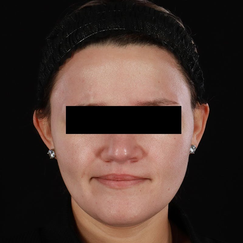 Botox/Dysport/Jeuveau Before & After Gallery - Patient 688390 - Image 4