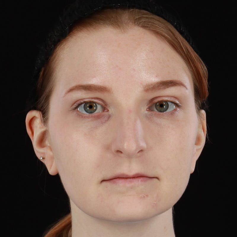 Botox/Dysport/Jeuveau Before & After Gallery - Patient 983573 - Image 4