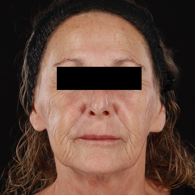 Renuva Before & After Gallery - Patient 257326 - Image 1