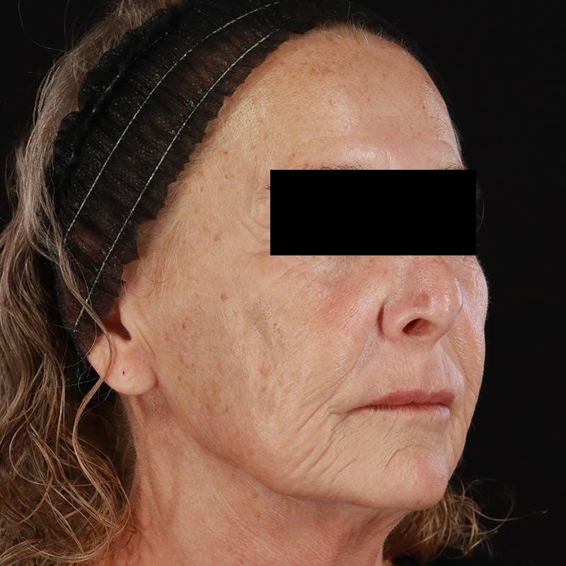 Renuva Before & After Gallery - Patient 257326 - Image 3