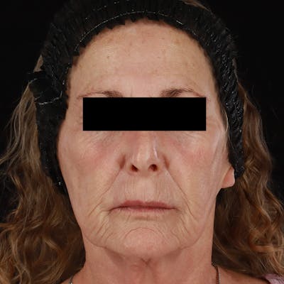 Renuva Before & After Gallery - Patient 257326 - Image 2