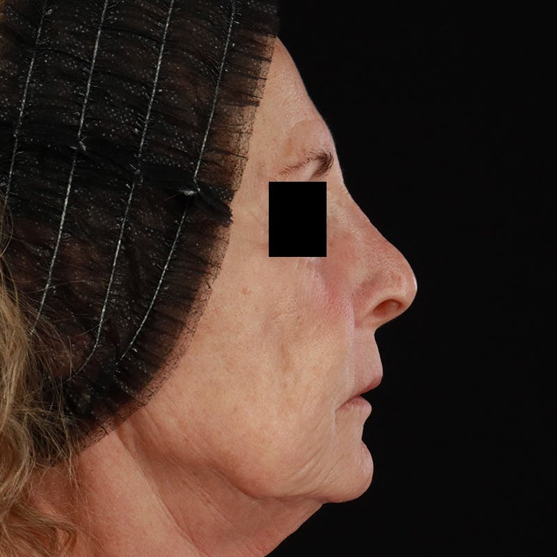 Renuva Before & After Gallery - Patient 257326 - Image 6