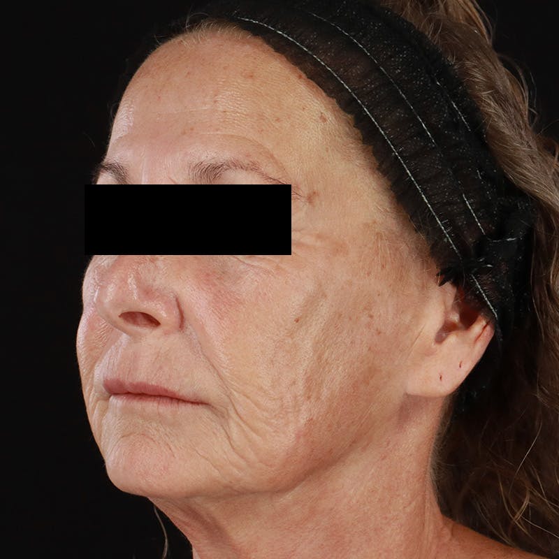 Renuva Before & After Gallery - Patient 257326 - Image 7