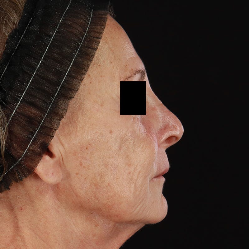 Renuva Before & After Gallery - Patient 257326 - Image 5