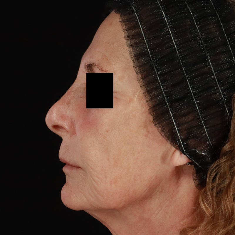 Renuva Before & After Gallery - Patient 257326 - Image 10