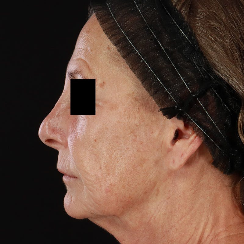 Renuva Before & After Gallery - Patient 257326 - Image 9