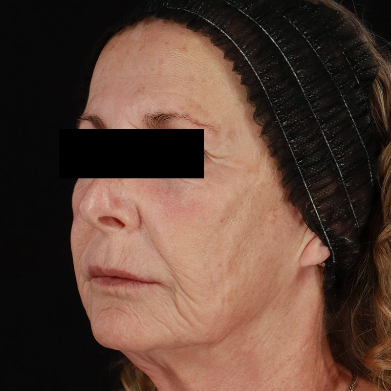 Renuva Before & After Gallery - Patient 257326 - Image 8