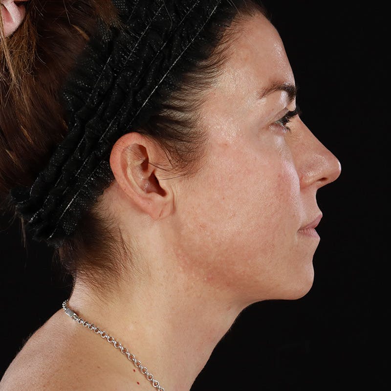 HALO™ Laser Treatment Before & After Gallery - Patient 457135 - Image 5