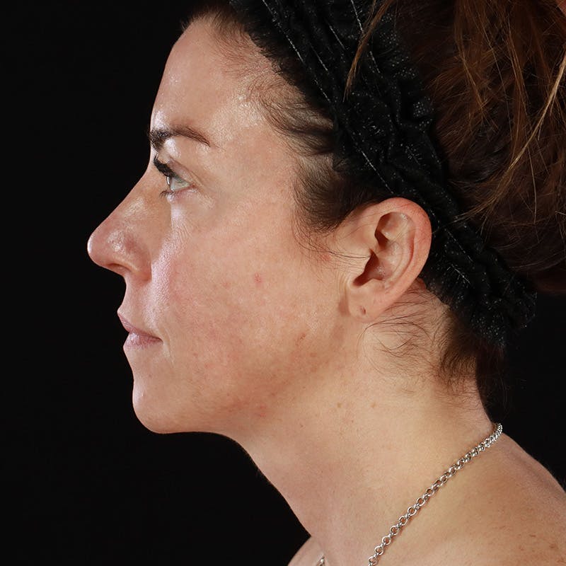 HALO™ Laser Treatment Before & After Gallery - Patient 457135 - Image 9