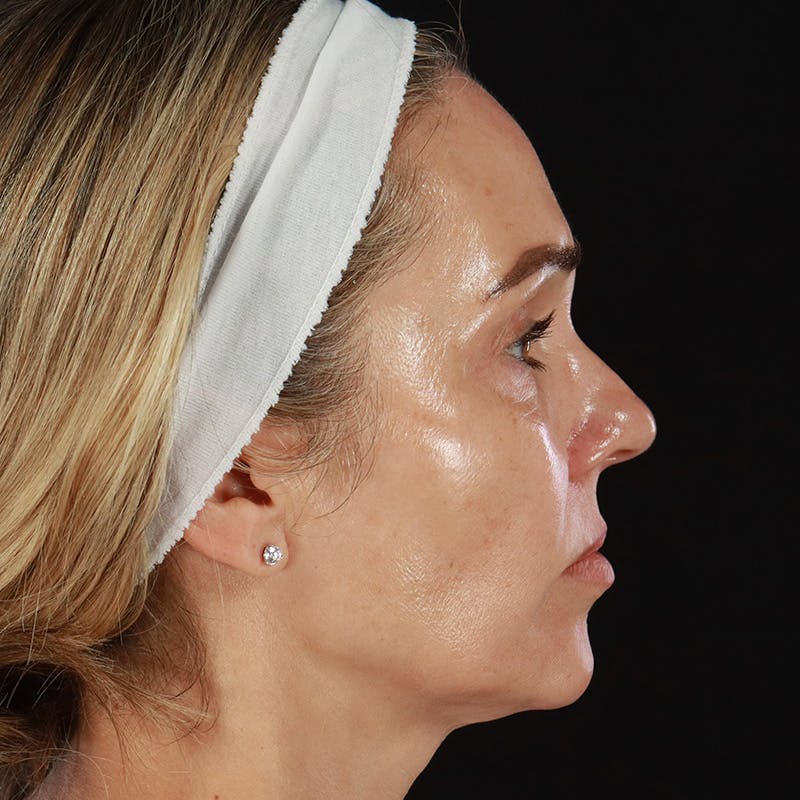 HALO™ Laser Treatment Before & After Gallery - Patient 978726 - Image 5