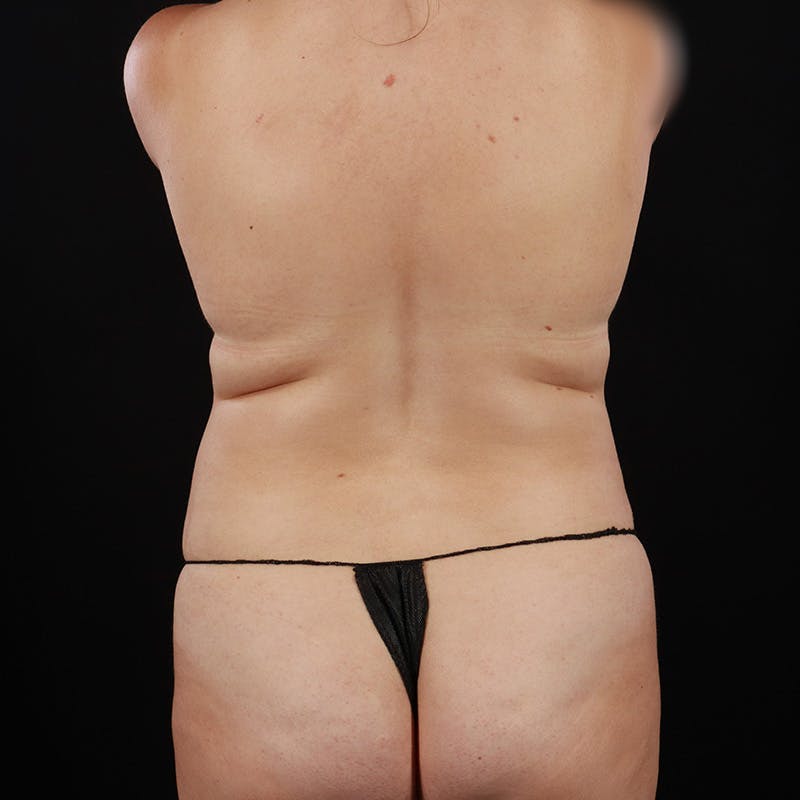 Abdominoplasty (Tummy Tuck) Before & After Gallery - Patient 594594 - Image 11