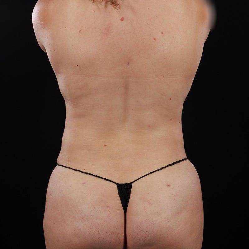Abdominoplasty (Tummy Tuck) Before & After Gallery - Patient 594594 - Image 12