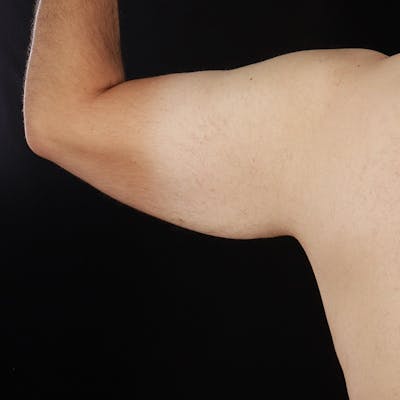 Arm Lift Before & After Gallery - Patient 422889 - Image 1
