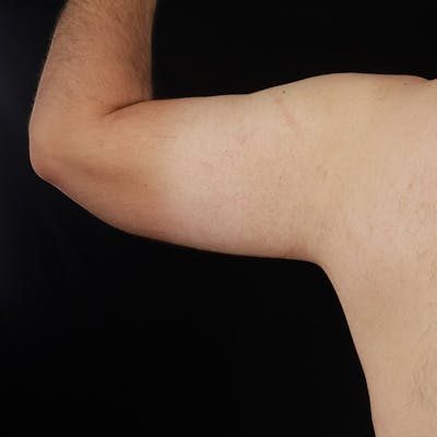 Arm Lift Before & After Gallery - Patient 422889 - Image 2