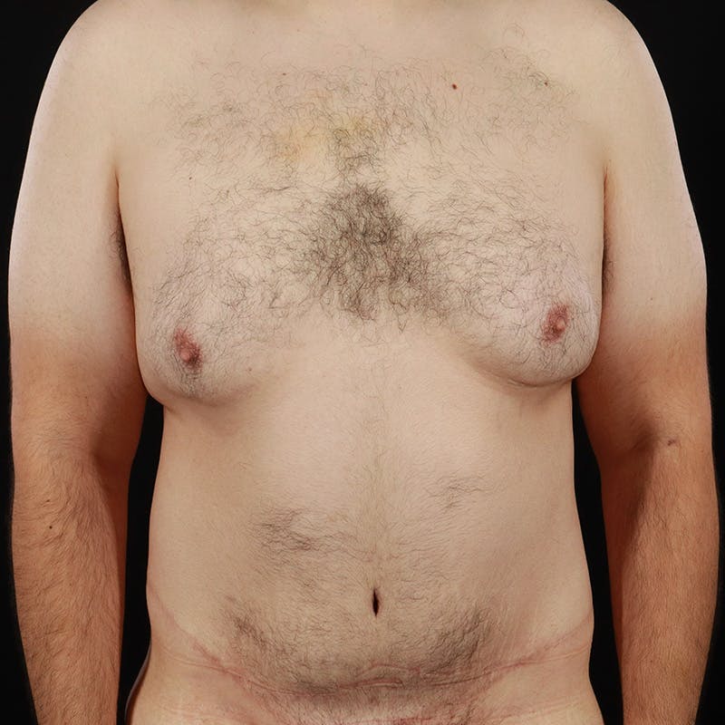 Male Liposuction Before & After Gallery - Patient 381319 - Image 1