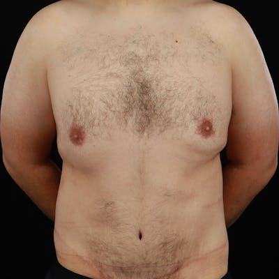 Gynecomastia Before & After Gallery - Patient 275896 - Image 2