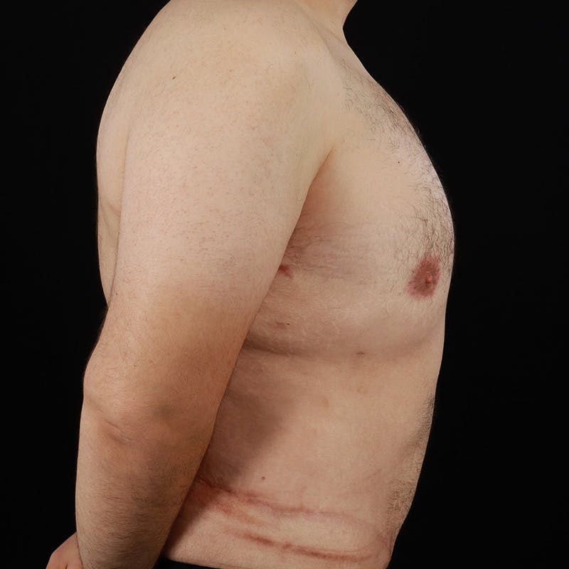 Male Liposuction Before & After Gallery - Patient 381319 - Image 6