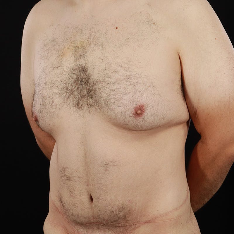 Body Contouring Before & After Gallery - Patient 314246 - Image 7